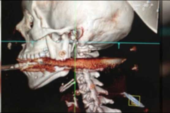 نیزه در گلویش فرو رفت زنده ماند