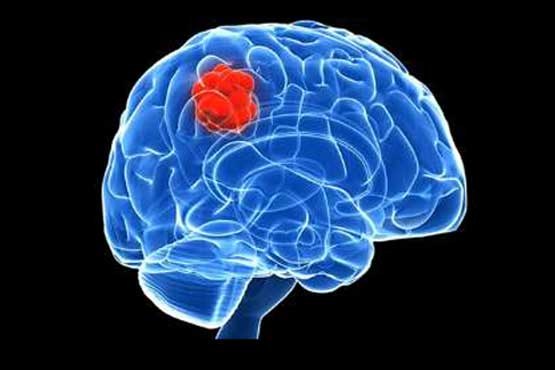 کشف پروتئین از بین برنده سلول های بدخیم تومور مغزی