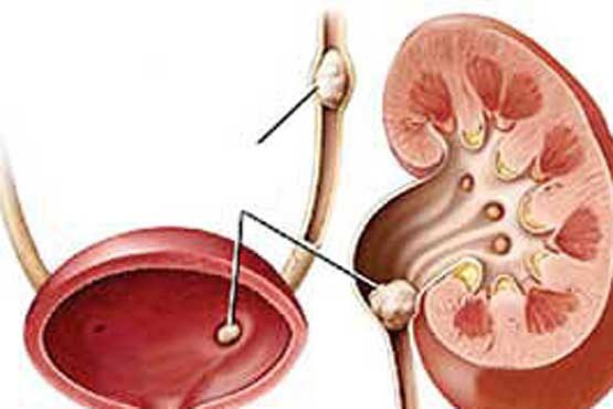 مبتلایان سنگ کلیه مُسکن نخورند