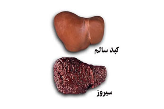 درمان کبد چرب با طب سنتی