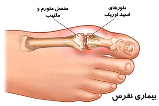 نقرس؛ بیماری اغنیای سابق