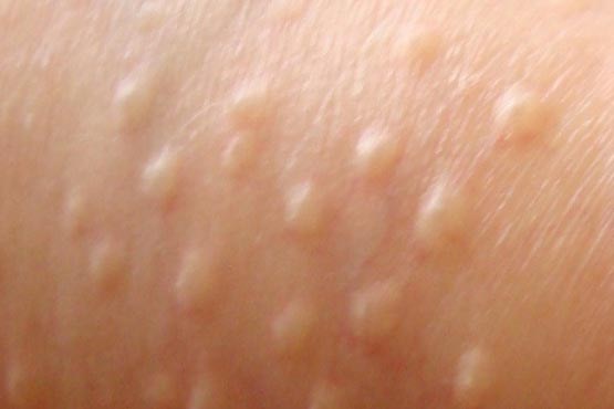 دانه‌های ریز پوستی زردرنگ، بیماری نیست