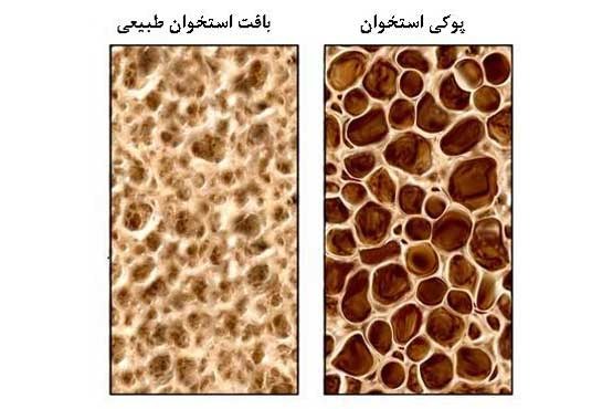 راهکارهایی برای پیشگیری از پوکی استخوان