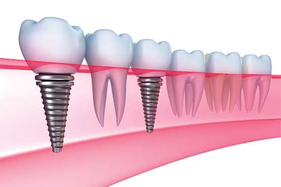 ایمپلنت؛ دندانی با ریشه تیتانیومی