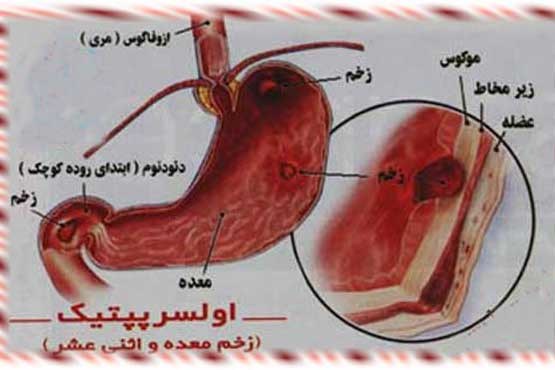 سوءهاضمه را بشناسید