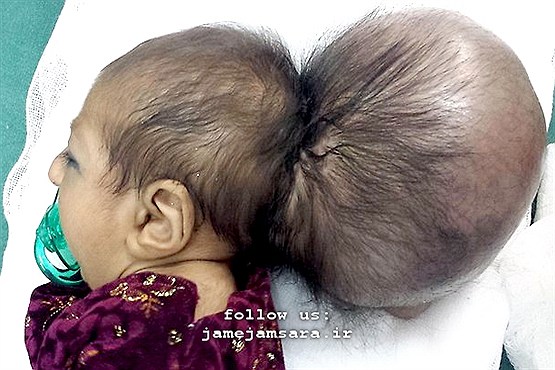 نوزادی با سر دوتکّه |عکس|