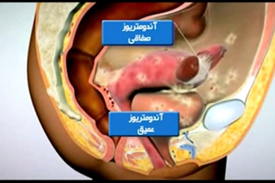آندرومتریوز؛ بیماری خاموش