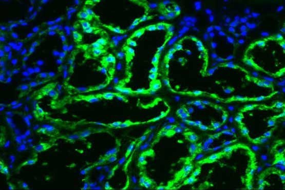 آنزیمی که سرطان کلیه را متوقف میکند آنزیمی که سرطان کلیه را متوقف میکند