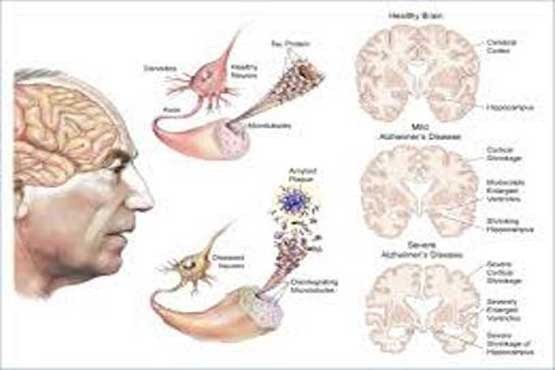 بیماری هایی که ابتلا به آلزایمر در دیابتی ها را افزایش می دهد