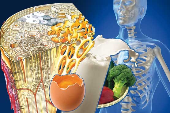 پوکی استخوان با تغذیه نامناسب