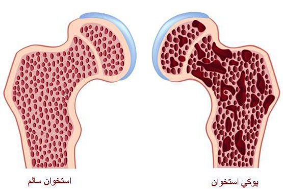 پوکی استخوان علیه طول عمر