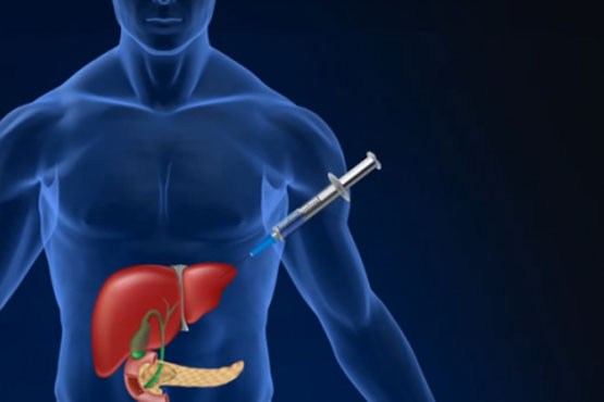 درمان دیابت با تبدیل سلول‌های کبد به تولیدکننده انسولین