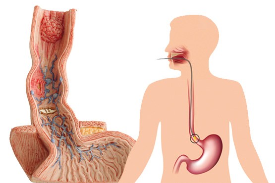 افزایش خطر سرطان مری با تغذیه ناسالم