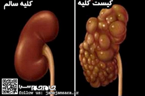 علل بروز، علائم و روش‌های درمان کیست کلیه