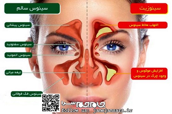 علائم و راه‌های تشخیص و درمان انواع سینوزیت