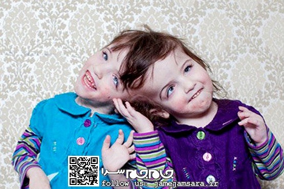 دوقلوهای به هم چسبیده آمریکایی [مجموعه‌عکس]