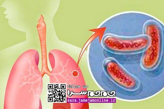دستاورد جدید محققان در درمان سل