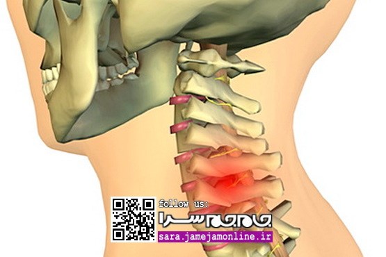 با مشاهده چه نشانه‌هایی باید گردن درد را جدی گرفت
