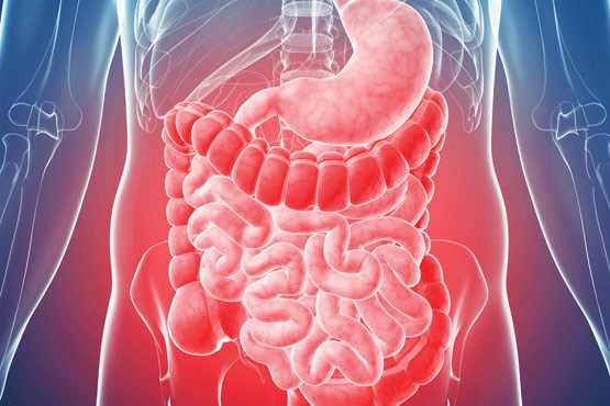 بیماری‌ای که روده را ملتهب می‌کند