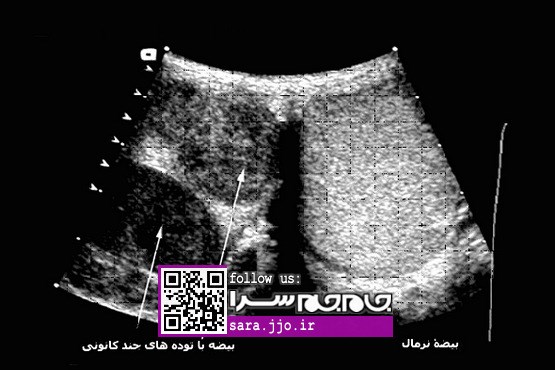 شیوع سرطان بیضه در پسران جوان