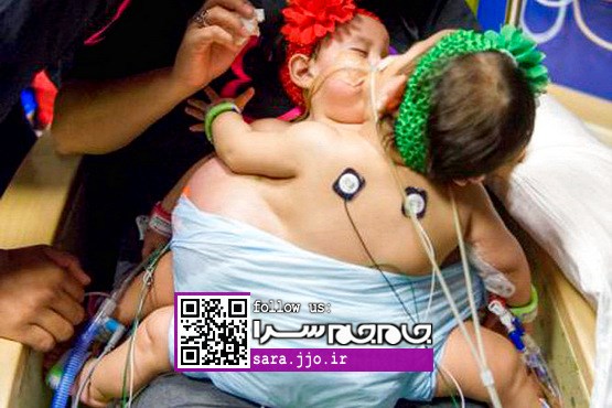 عمل جداسازی دوقلوهای به هم چسبیده در امریکا [مجموعه عکس]