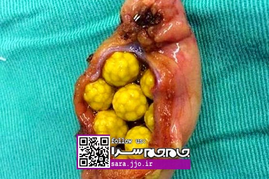 شاید تاکنون ندیده باشید: «سنگ کیسه صفرا» [عکس]