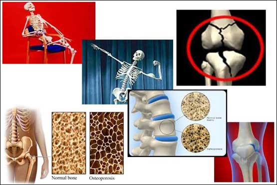 اشتباهاتی که استخوان ها را ضعیف می کند