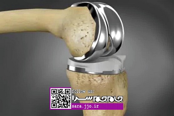 دردسرهای پس از جراحی پروتز در ناحیه زانو