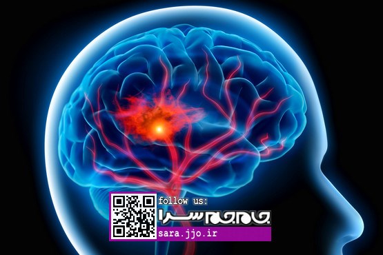 علائم و نشانه‌های سکته مغزی / 3 تا 4.5 ساعت زمان طلایی را از دست ندهید