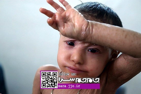 «ملیکا»؛ دختری که در پوست خود می‌سوزد [عکس]