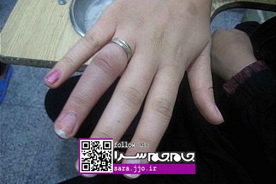 انگشتر تنگ، اشک دختر نوجوان را درآورد [+عکس]