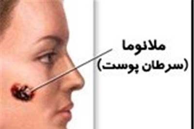 تشخیص زودرس سرطان های پوست در رادیو سلامت