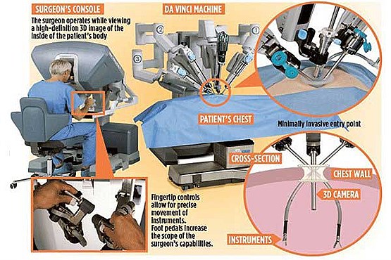 روبات داوینچی سرطان ریه را جراحی کرد