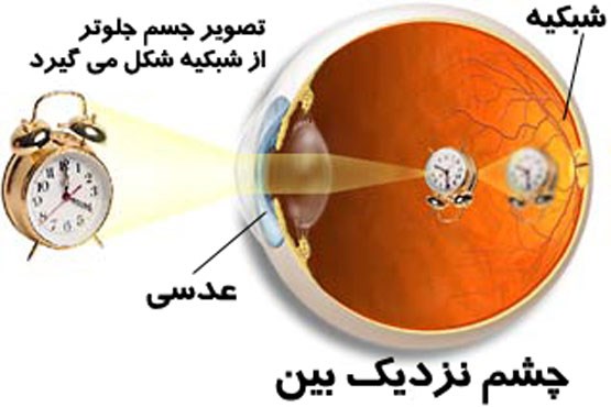 چشمانی که نزدیک‌بین می‌شوند