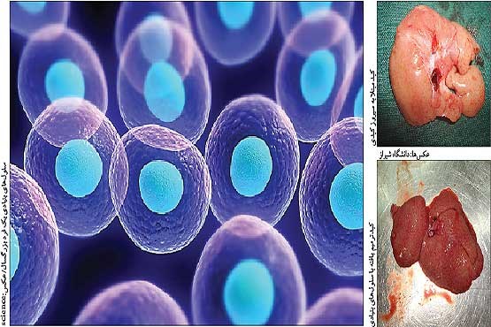 سلول‌های بنیادی، کلید درمان سیروز کبدی