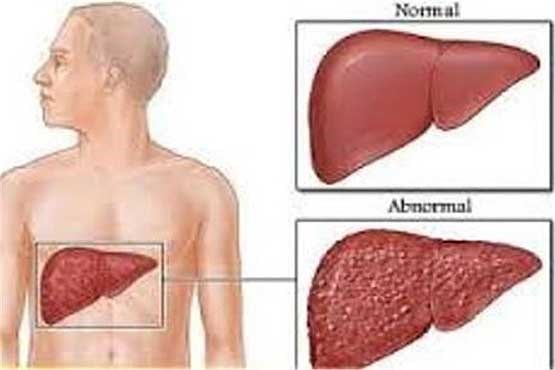 درباره سرطان کبد چه می دانید؟