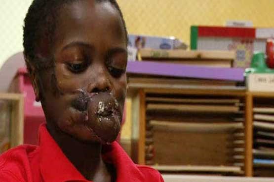 شامپانزه‌ها دهان کودک 8 ساله را دریدند + عکس