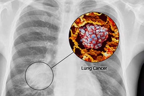 علائم مهم سرطان ریه