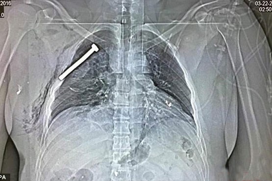 میخ 7 سانتی در سینه یکی از بازماندگان حادثه بروکسل
