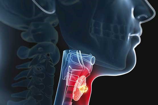 نقش 95 درصدی استعمال سیگار در بروز سرطان حنجره