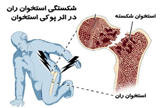 پوکی استخوان را چقدر می‌شناسید؟