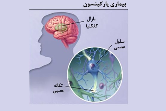 نشانه‌های مهم بیماری پارکینسون چیست؟