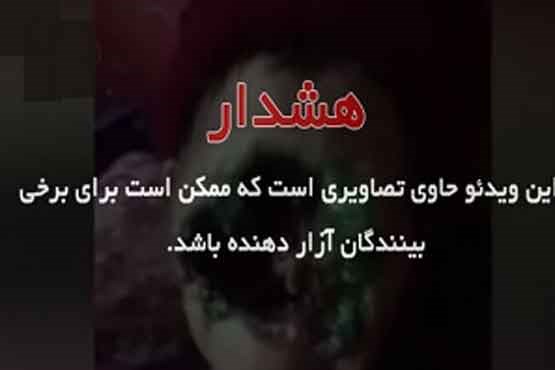 خورده شدن صورت زنی توسط باکتری گوشتخوار
