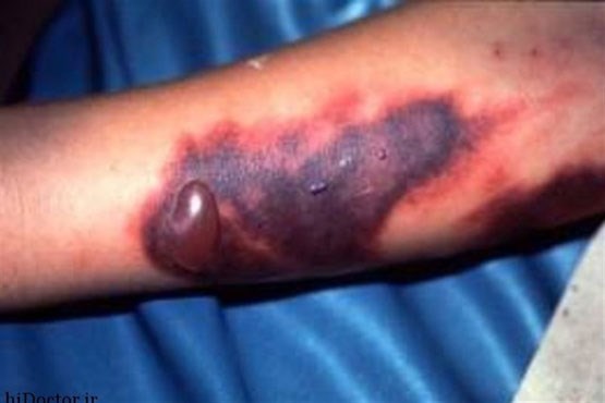 مبارزه با "تب کریمه کنگو" در ۵ استان تشدید شد