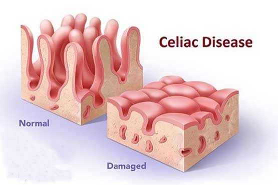 بیماری سلیاک چیست؟