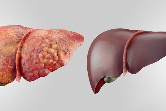 علل بروز کبد چرب چیست؟