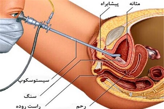 آشنایی با دلایل ابتلا به سنگ مثانه