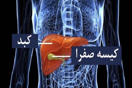 آنچه درباره سنگ «کیسه صفرا» باید بدانید