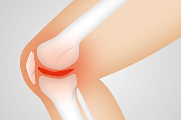 ژنتیک و پارگی رباط صلیبی