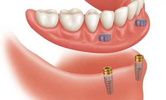 انواع روش های کاشت دندان